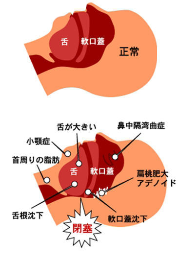 無 呼吸 症候群 チェック